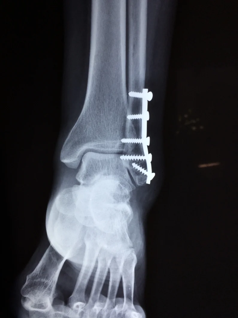 Traumafysiotherapie